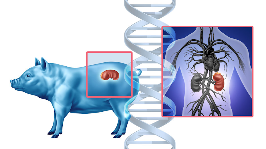 Medical Breakthrough: Woman With Pig Kidney Defies the Odds-2