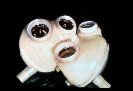 What We Know 30 Years Since the First Artificial Heart-3